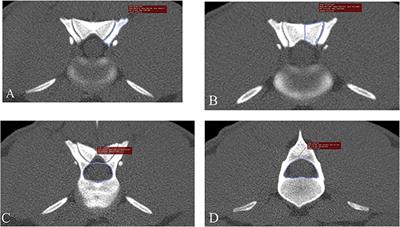 Computed Tomographic Measures of Funnel-Shaped Lumbar Vertebral Canal and Articular Process Dysplasia Malformations Differ Between German Shepherd and Belgian Malinois Military Working Dogs